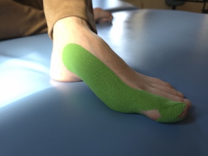 Zdjęcie stopy z naklejoną taśmo do kinesiotapingu w ramach leczenia palucha koślawego.